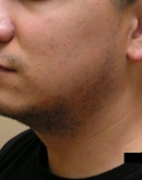 Before Beard Hair Transplant, Pair 3