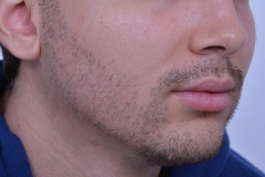 After Beard Hair Transplant