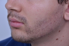 After Beard Hair Transplant photo